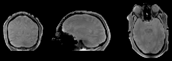 Premières images IRM in vivo en transmission parallèle à 7 teslas : une collaboration DSM-DSV fructueuse